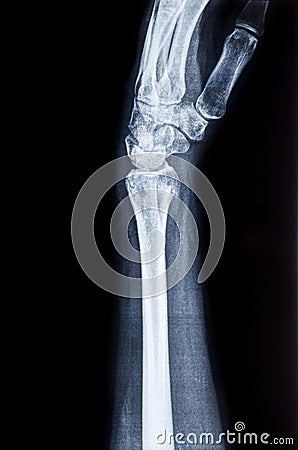 X-ray of the wrist and human radius Stock Photo