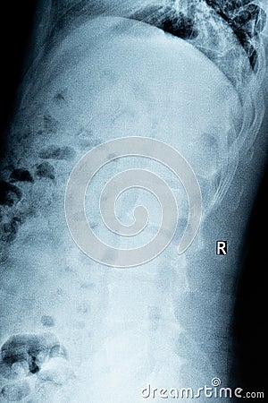 X-rays of lumbar mild hyperost Stock Photo