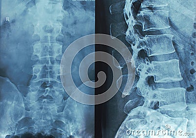 X-rays of the spine Stock Photo