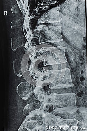 X-rays of the spine Stock Photo