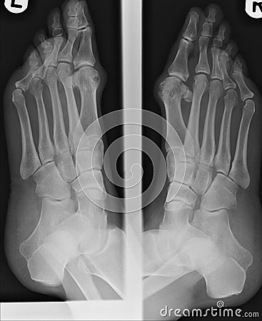 Xray of bunions Stock Photo