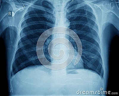 Xray chest Stock Photo