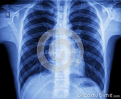 Xray chest Stock Photo