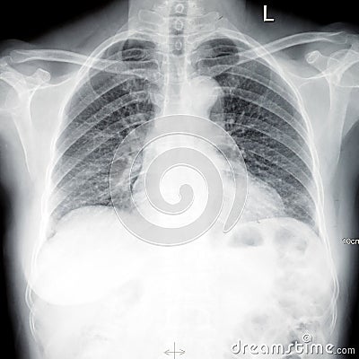 ct Xray chest scan film Stock Photo