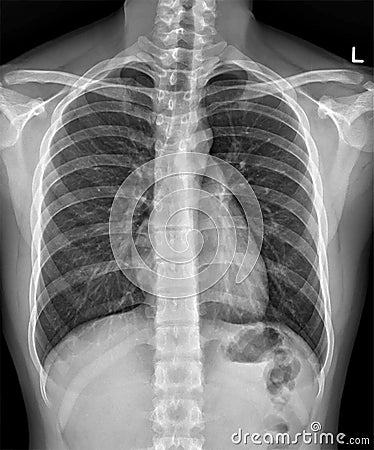 Xray for diagnosis of pneumonia, tuberculosis TB and silicosis. Stock Photo