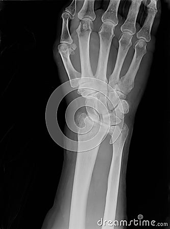Xray of epiphysial radial fracture reduced with permanent synthetic means Stock Photo
