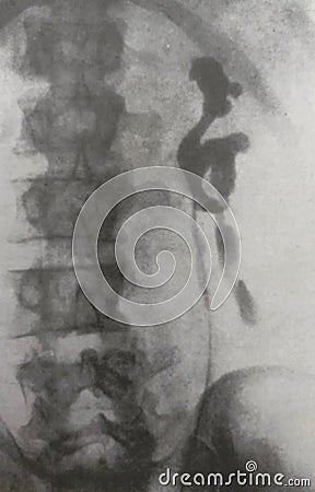 Xray examination abdomen kidney shrapnel war victim Stock Photo