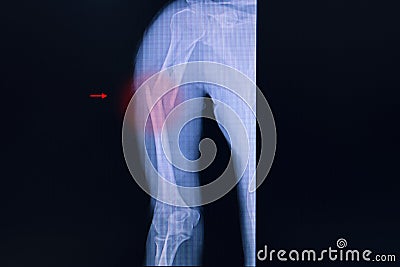 Xray film of an arm with fractured humerus Stock Photo