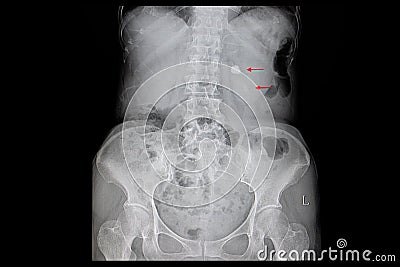 Xray film of a large stone in the right kidney Stock Photo