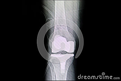 Total knee arthroplasty Stock Photo