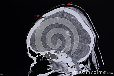 Xray film of skull fractures Stock Photo