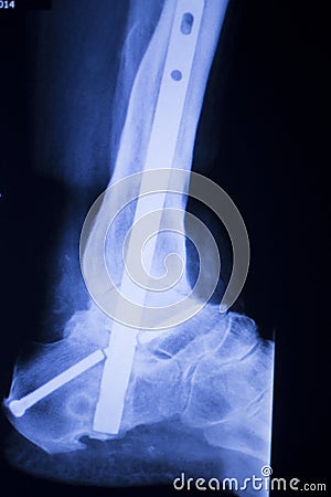 Xray foot heel ankle scan Stock Photo