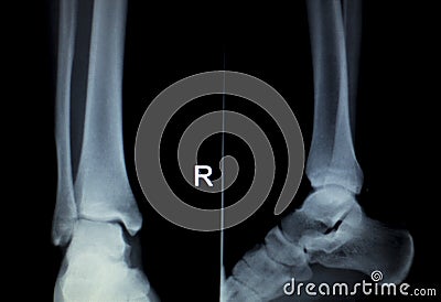 Xray foot heel ankle scan Stock Photo