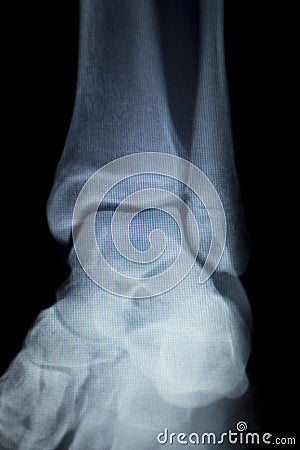 Xray foot heel ankle scan Stock Photo