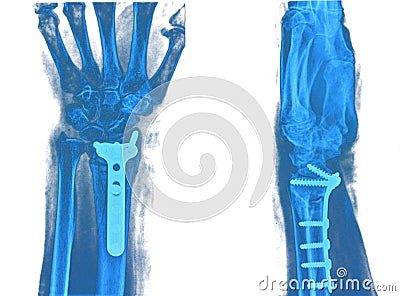 Xray of hand Stock Photo