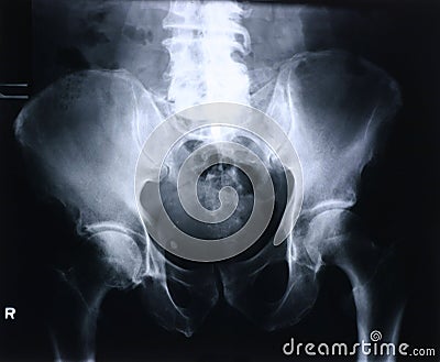 Xray/hip Stock Photo