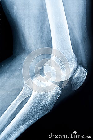 Xray of a human knee Stock Photo