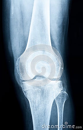 Xray of a human knee Stock Photo