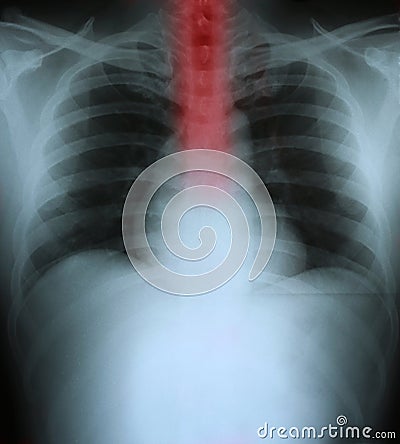 Xray of a human thorax with esophagus highlighted Stock Photo