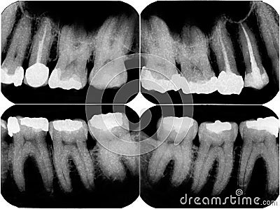 Xray image of capped tooth Stock Photo