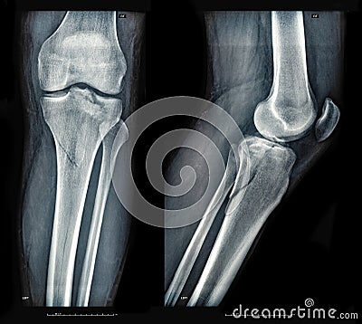 Xray images showing real fracture of leg bone under the knee after injury Stock Photo