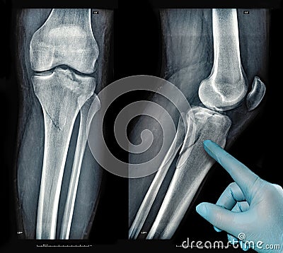 Xray images showing real fracture of leg bone under the knee after injury Stock Photo