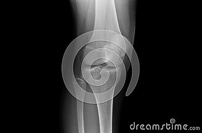 Xray Knee Joints of an Adolescent Stock Photo