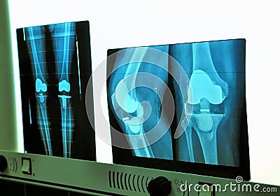 Xray knee prosthesis Stock Photo