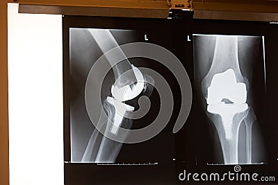 Xray knee replacement Stock Photo