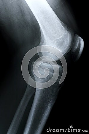 Xray/Knee side Stock Photo