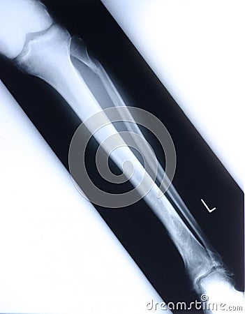 Xray/leg Stock Photo