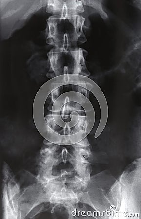 Xray, Lumbar Spine Stock Photo