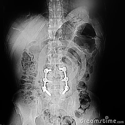 Xray lumbar spine vertebrae pathology with hardware Stock Photo
