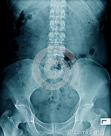 Xray lumbar Stock Photo