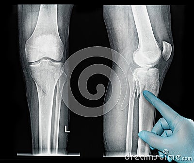 Xray images showing real fracture of leg bone under the knee medical glove point out Stock Photo