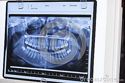 Xray Panoramic Dental Stock Photo