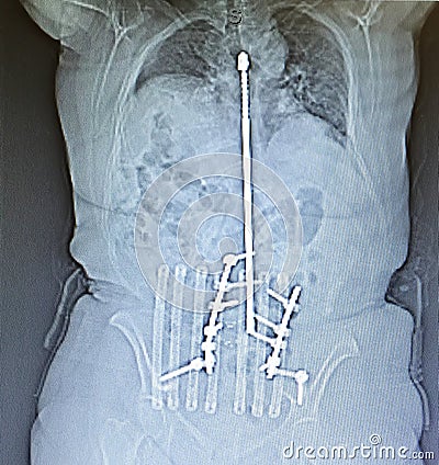 Xray posterior harrington rod spinal vertebrae pathology Stock Photo