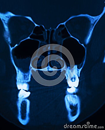 Xray scan skull nose Stock Photo