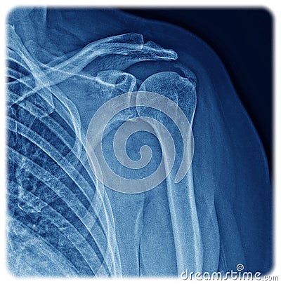 Xray Shoulder Stock Photo