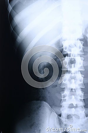 Xray/spine 2 Stock Photo