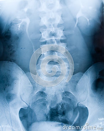 Xray Spine Human Stock Photo