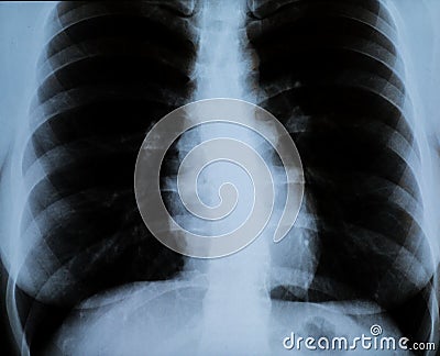 XRay of a woman`s chest Stock Photo