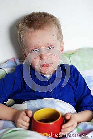 Boy with chickenpox Stock Photo