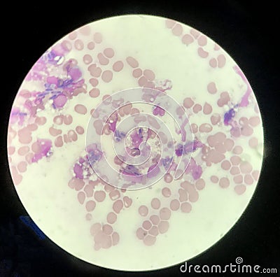 Yeast cells phagocytosis by white blood cell in blood smear Stock Photo