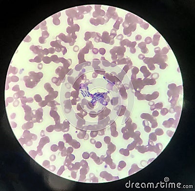 Yeast cells phagocytosis by white blood cell in blood smear Stock Photo