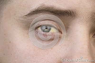 The yellow color of the male eye. Symptom of jaundice, hepatitis or problems with the gall bladder, gastrointestinal tract, liver Stock Photo