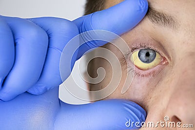 The yellow color of the male eye. Symptom of jaundice, hepatitis or problems with the gall bladder, gastrointestinal tract, liver Stock Photo