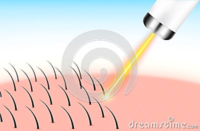 Yellow laser light hair removal unwanted out make skin smooth. Medical beauty concept. Vector Illustration