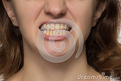 Yellow is not even and crooked teeth of a young woman Stock Photo