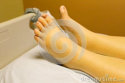 Yellow, swollen ankles and feet due to alcoholism Stock Photo